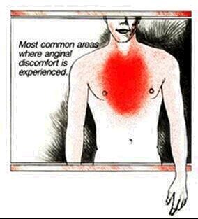 Areas of anginal discomfort